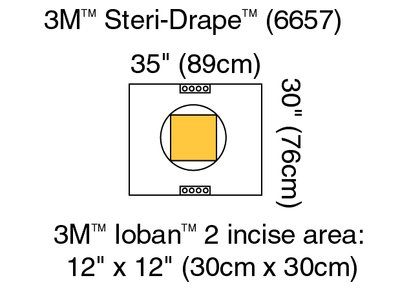 3M Steri-Drape Cesarean-Section Sheets & Pouches Case 6657 By 3M H